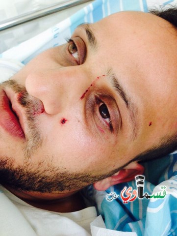 حيفا: قطعان من المتطرفين اليهود يعتدون على الشاب آدم الفقير (25 عاما) من قرية ابطن،